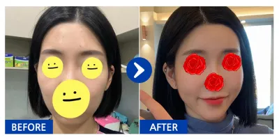 [강남언니] 지방이식 / 닉네임:태히히힣ㅎㅎ