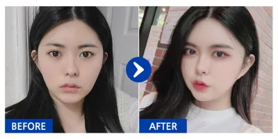 [바비톡] 지방이식, 안면윤곽, 쌍꺼풀 / 3개월차/ 닉네임:우아어아아아