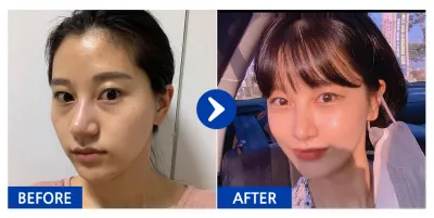 [바비톡] 지방이식 / 5개월차/ 닉네임:아멜리칼노