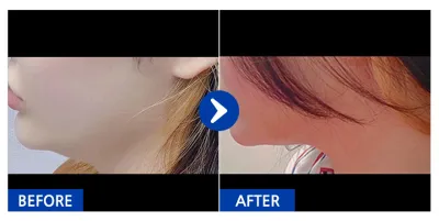 [강남언니] 지방흡입 / 닉네임:BYJ72