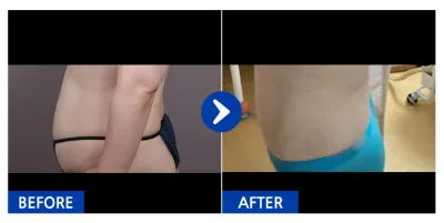 [바비톡] 지방흡입 / 1개월차/ 닉네임:꽃다운그자