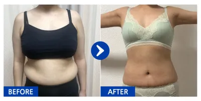 [바비톡] 복부, 팔뚝 지방흡입 / 5개월차/ 닉네임:먹지마아는맛