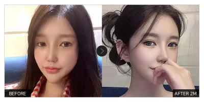 [강남언니 후기]  눈매교정, 눈재수술 한 달차 / 닉네임 : wingit