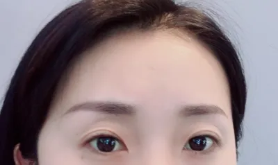 [눈] 김정 김점 - 뒤트임, 밑트임