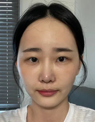 [눈] 소소 - 매몰쌍커풀, 앞트임, 밑트임