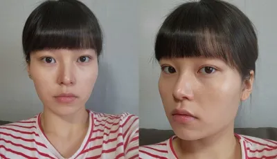 [안면윤곽] 뇸뇸씨 - 안면윤곽