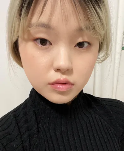 [눈] 몽시리 - 비절개눈매교정