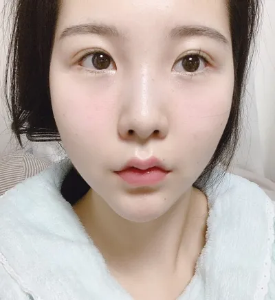 [눈] 겨울 - 절개쌍꺼풀(재수술), 앞트임(재수술), 밑트임