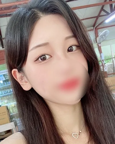 [눈] 투리구슬 - 매몰쌍꺼풀(재수술),밑트임