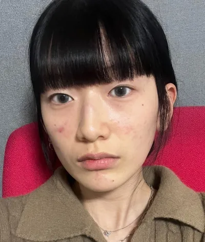 [눈] 이슬 - 비절개눈매교정