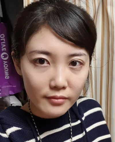 [눈] 긍정 - 절개쌍꺼풀 재수술