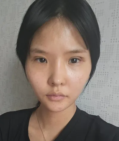 [눈] 민초단 - 절개눈매교정,앞트임,뒤트임,밑트임 재수술