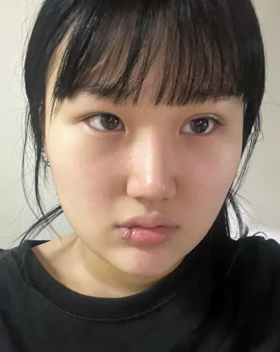 [눈] 회색바나나 - 절개쌍꺼풀 재수술, 앞트임