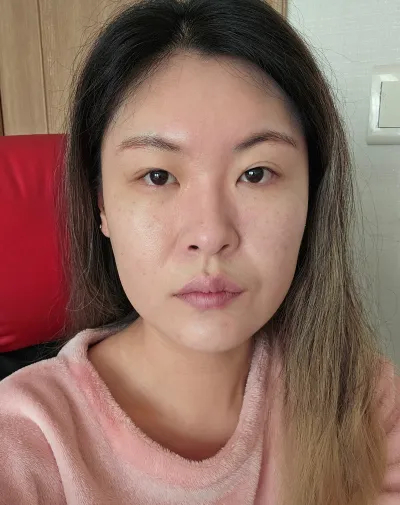 [눈] 초로기 - 매몰쌍꺼풀, 뒤트임, 밑트임