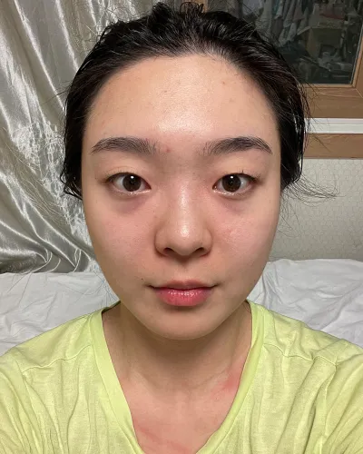 [눈] 판판다 - 눈밑지방재배치