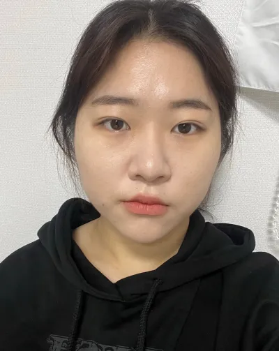 [눈] 체리젤리 - 뒤트임, 밑트임