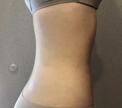 [지방흡입] 별처럼날아라 - 복부, 종아리 지방흡입