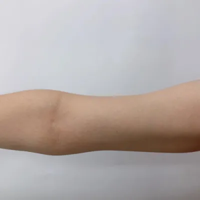 [지방흡입] 핫썸머썸머 - 팔 지방분해주사