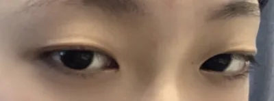 [눈] kkmmgg52 - 쌍꺼풀(매몰)