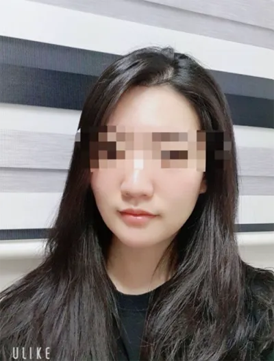 [쁘띠] [준회원ngR5DA2] - 슈링크, 보톡스