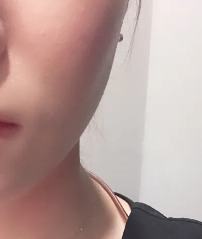 [피부] sang13 - 슈링크