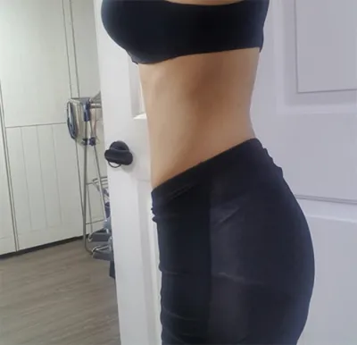 [지방흡입] 쥬비덤 - 지방흡입(복부)