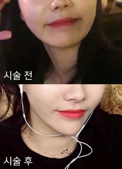 [쁘띠] 얄라숑쓰 - 무턱필러