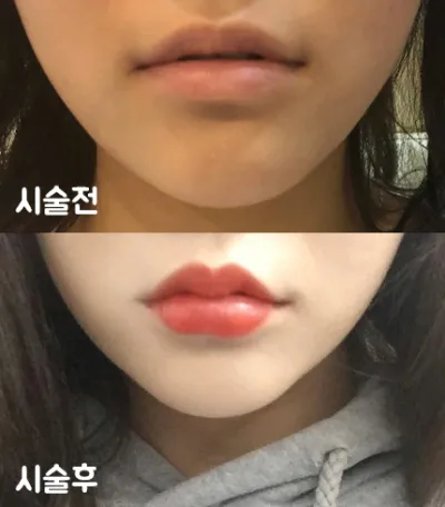 [쁘띠] bobommm - 입술필러