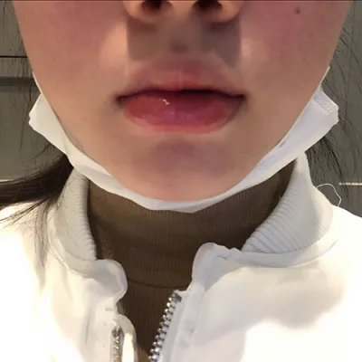 [쁘띠] 뀨꺙팡이 - 입술필러