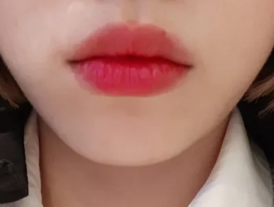 [쁘띠] 디아루파 - 필러, 보톡스