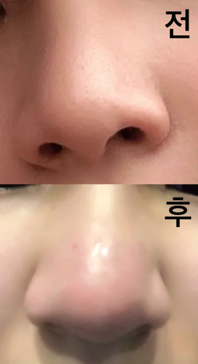 [쁘띠] 입뜔 - 코조각주사