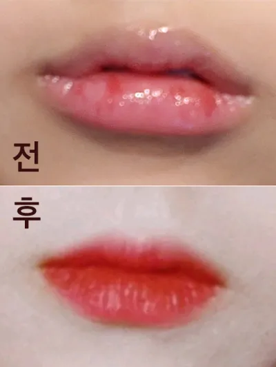 [쁘띠] 입듈 - 필러,보톡스