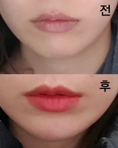 [쁘띠] 큽 - 턱끝필러,보톡스