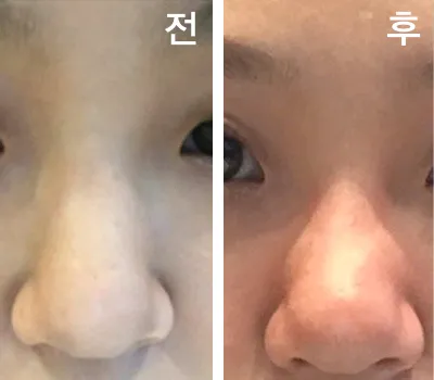 [쁘띠] 뀨잉3535 - 코조각주사