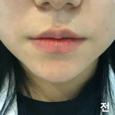 [쁘띠] 또또루야 - 입술필러,보톡스