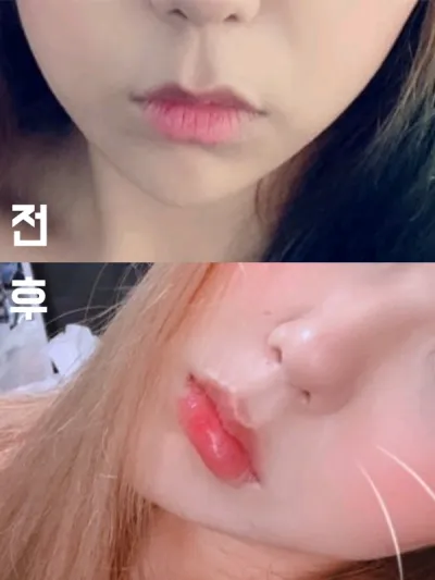 [쁘띠] 치치케 - 입술필러