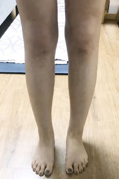 [지방흡입] 꿀타빈 - 종아리,복부지방흡입