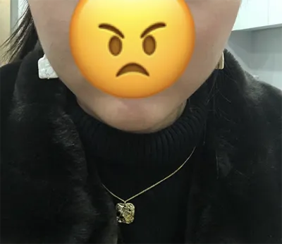 [쁘띠] 민자니 - 보톡스, 턱끝필러