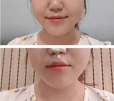 [피부] 돗트누리 - 실리프팅,슈링크