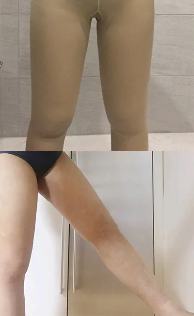 [지방흡입] 꺅긱꺅 - 지방흡입