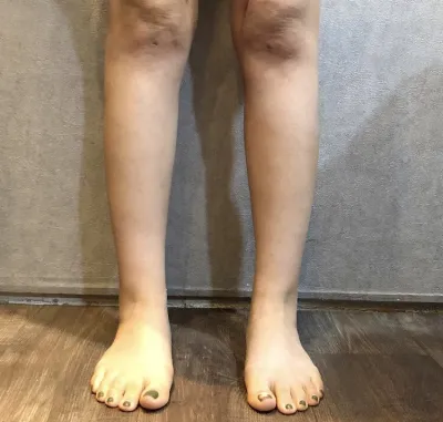 [지방흡입] 별처럼날아라 - 종아리, 복부 지방흡입