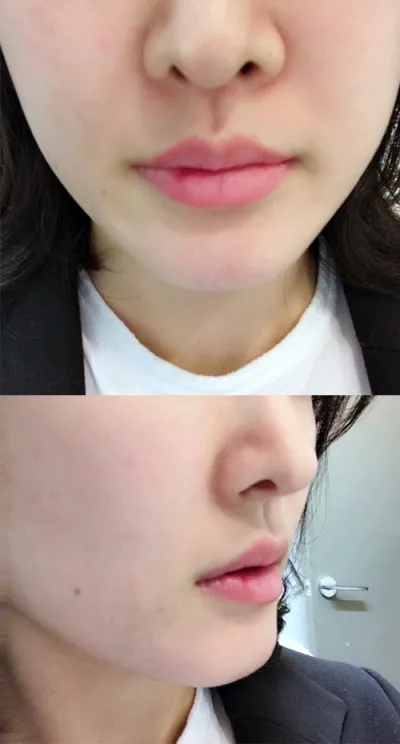 [쁘띠] 홍홍도도 - 입술필러