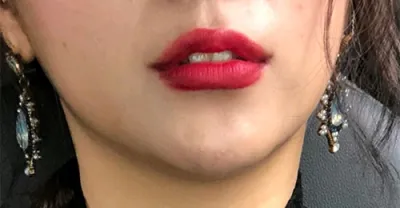 [쁘띠] 여구나 - 입술필러