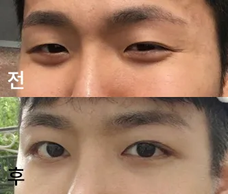 [눈] 치르니오 - 눈