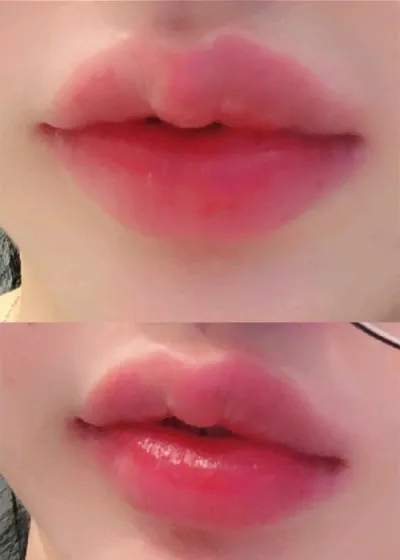 [쁘띠] 윤윤윤윤윤윤2 - 입술필러