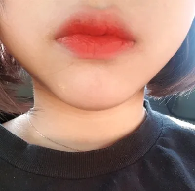 [쁘띠] awdrgyj - 입술필러,보톡스