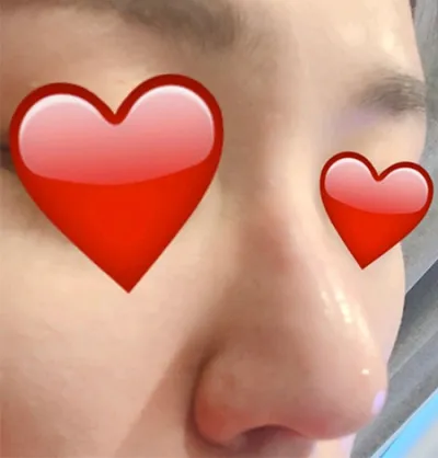 [쁘띠] 2080치야쿠 - 코조각주사,보톡스