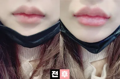 [쁘띠] 여어엉엉 - 입술필러