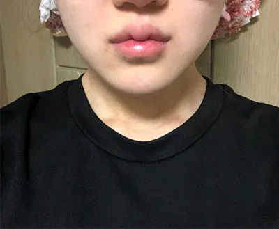 [피부] 쁑귱 - 슈링크