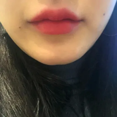 [쁘띠] hjhsjs - 턱보톡스,필러